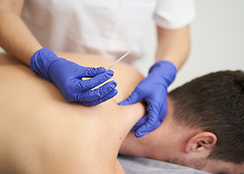 Dry Needling Edmonton | In Step Physical Therapy Clinic